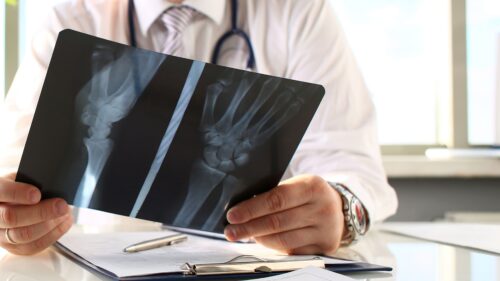 Le cancer des os est une maladie qui existe. Vrai ou faux ? 
