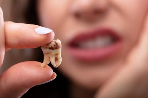 Qu’est-ce qui provoque des caries sur les dents ? 